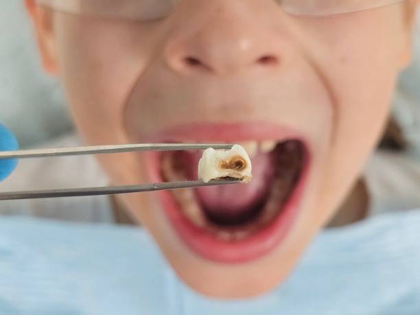 Best Broken or Cracked Tooth Emergency Dentist in Honsville, GA